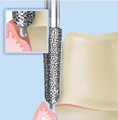 Pin Preparation Safe-End Bur